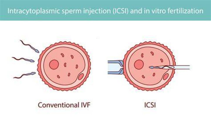 Can I have a boy with ICSI?