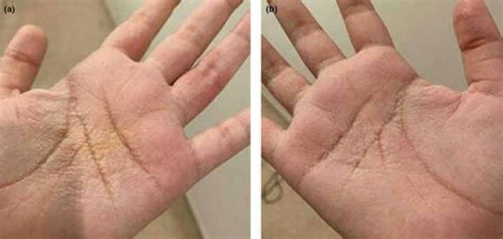 Does aquagenic wrinkling go away?