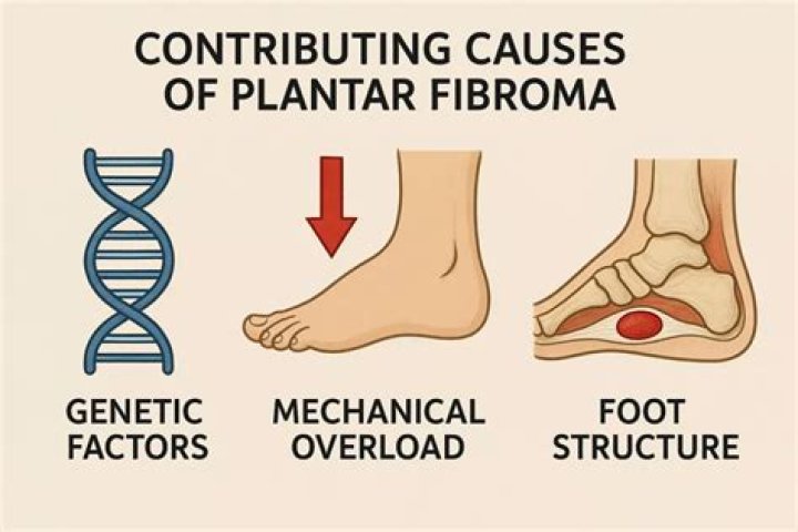 Does glucosamine cause plantar fibroma?