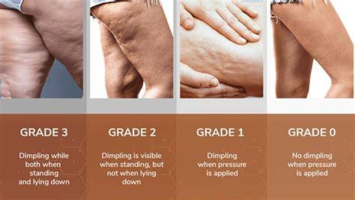 How do you break up cellulite fascia?
