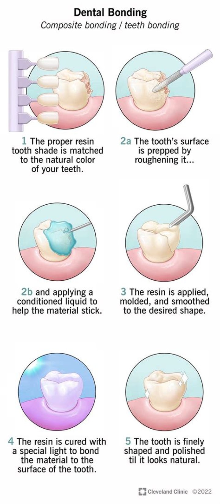 How do you brush bonded teeth?