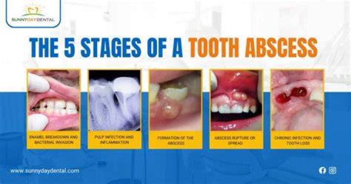 What happens if you don't get an abscess treated?