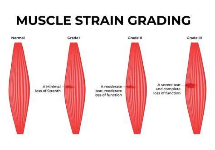 What is a grade 3 muscle strain?